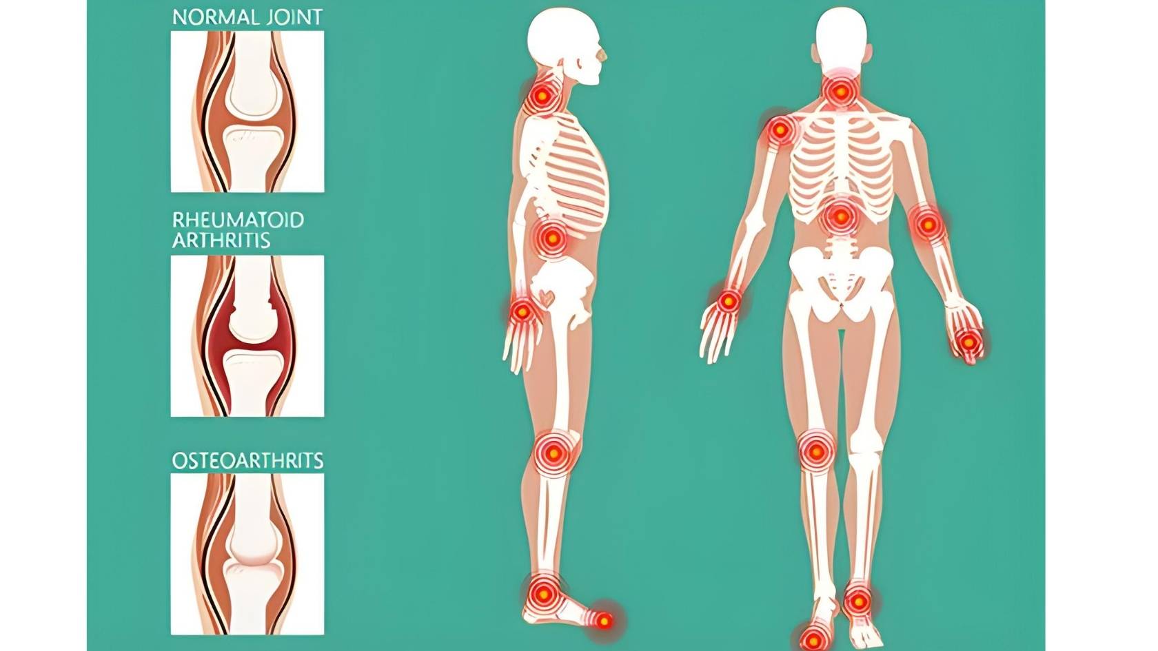 What is arthritis?