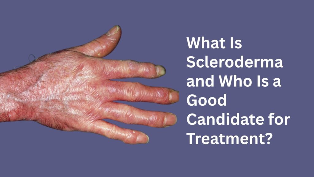 Hand showing skin thickening and tightness illustrating scleroderma symptoms