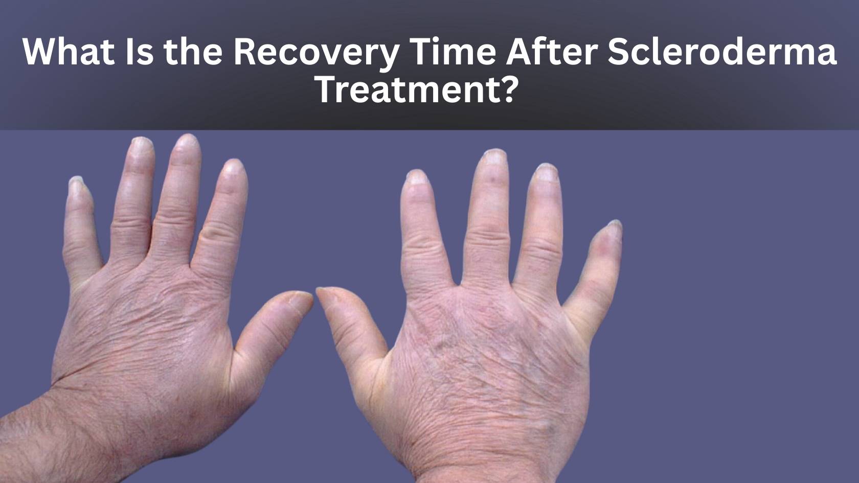 Back Problems Sceloderma Recovery Time After Scleroderma Treatment Explained
