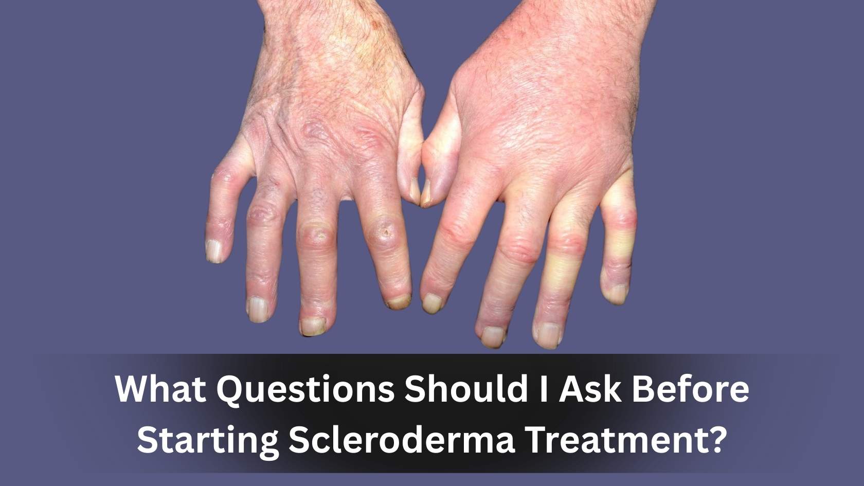 Back Problems Sceloderma What Questions Should I Ask Before Starting Scleroderma Treatment?