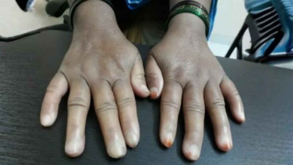 Scleroderma consultation