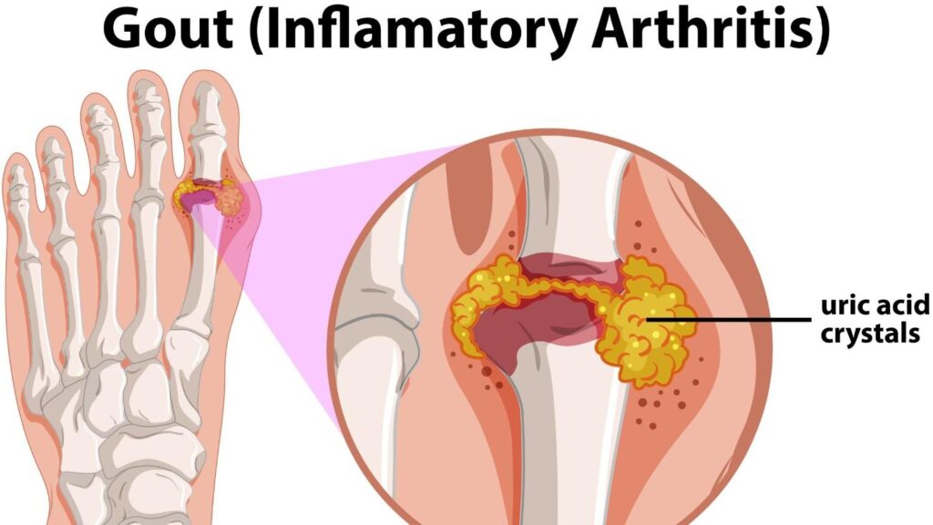 Educational medical diagram of gout showing uric acid crystal deposits inside an inflamed toe joint, illustrating inflammatory arthritis and joint swelling in the foot.