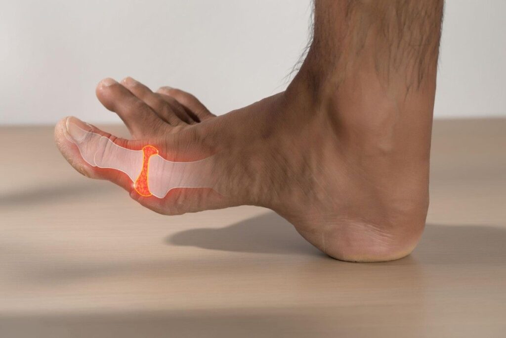 Can Uric Acid Be Controlled Permanently? Illustration showing gout-related inflammation in the big toe joint caused by elevated uric acid crystal deposits.